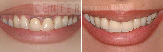 functional crown lengthening 3