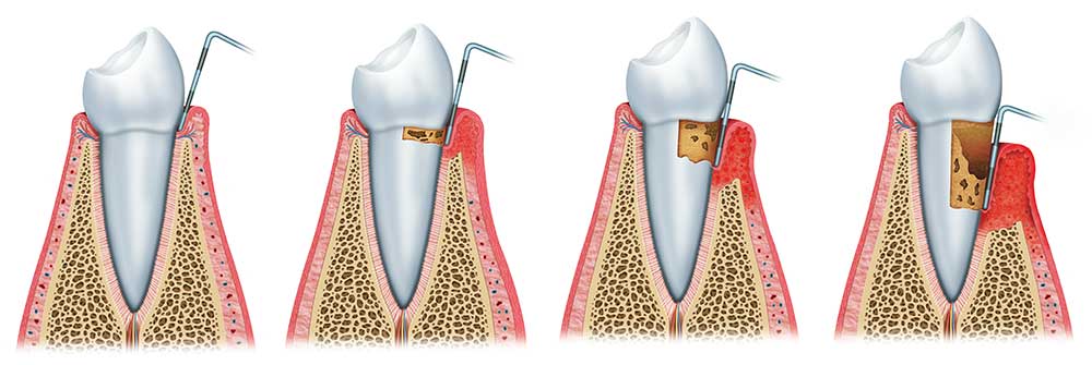 periodontal pockets at various stages of gum disease