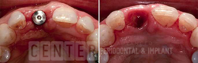 gum graft around implant before after
