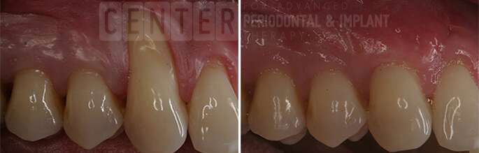 gum graft before after 1