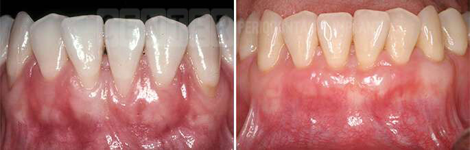 gum graft before after 2