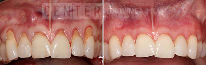 gum graft before after 3