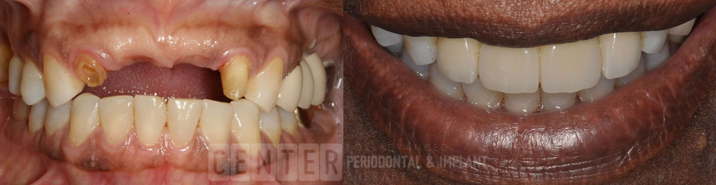 single tooth implant before after