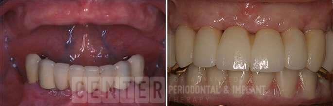 multiple teeth implant before after