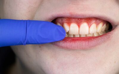 What are the Stages of Periodontal Disease?