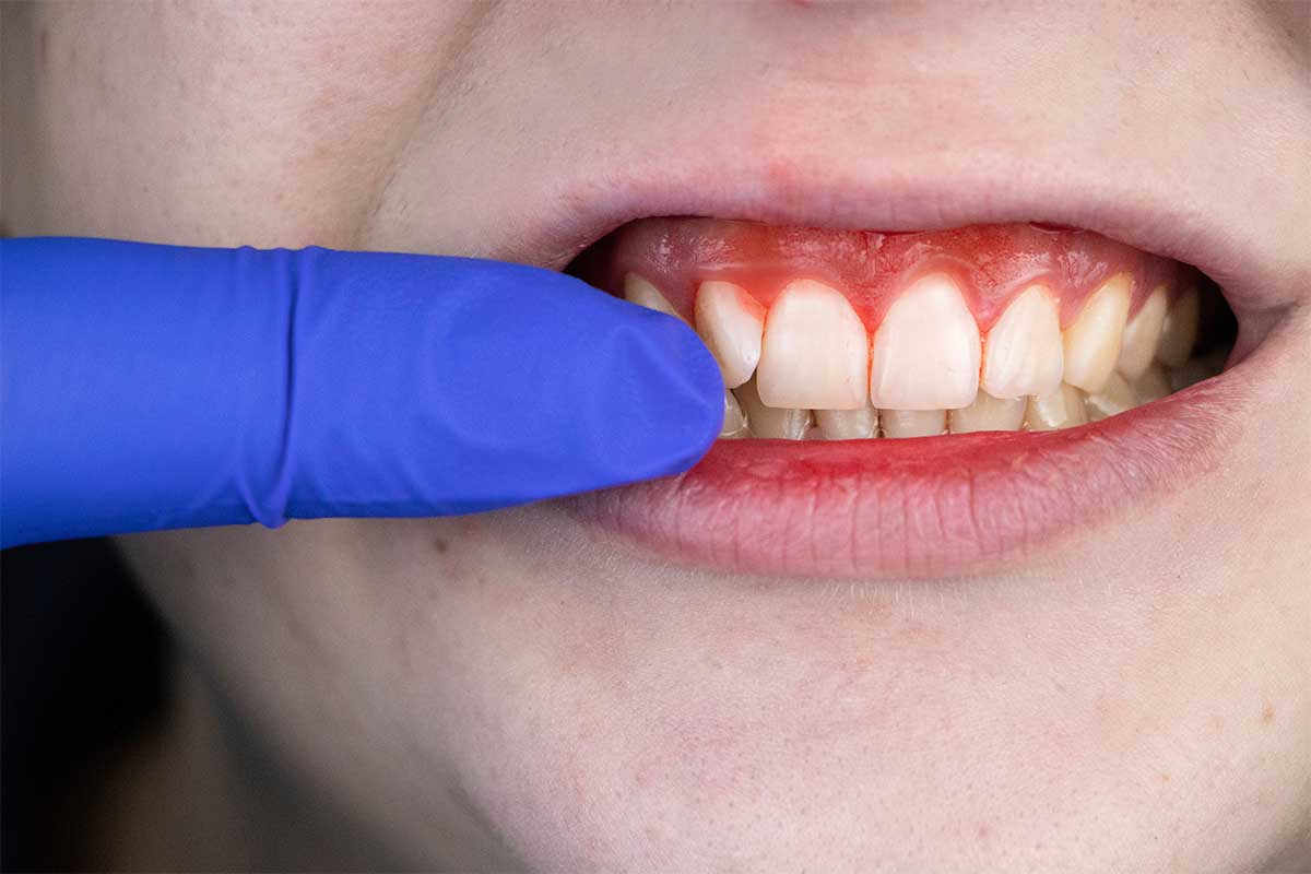 gingivitis gum bleeding and inflammation close up