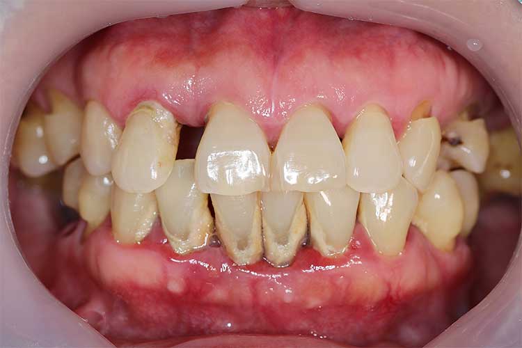 Periodontitis Gum Disease patient up close