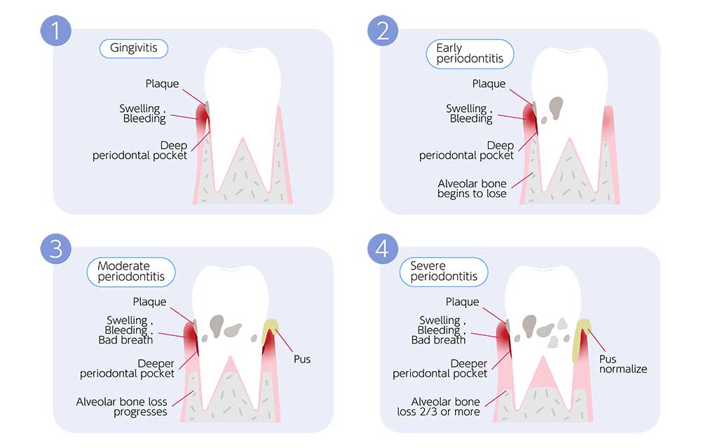 Stages of Periodontal disease progression illustration