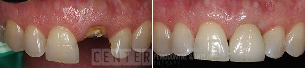 single tooth implant before after