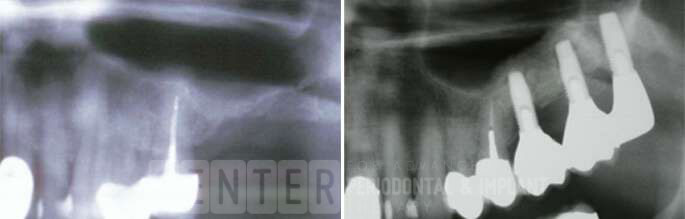 sinus bone graft before after