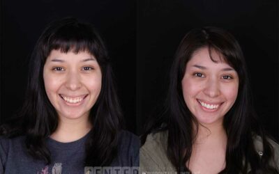 Improve Your Smile With Cosmetic Gum Surgery