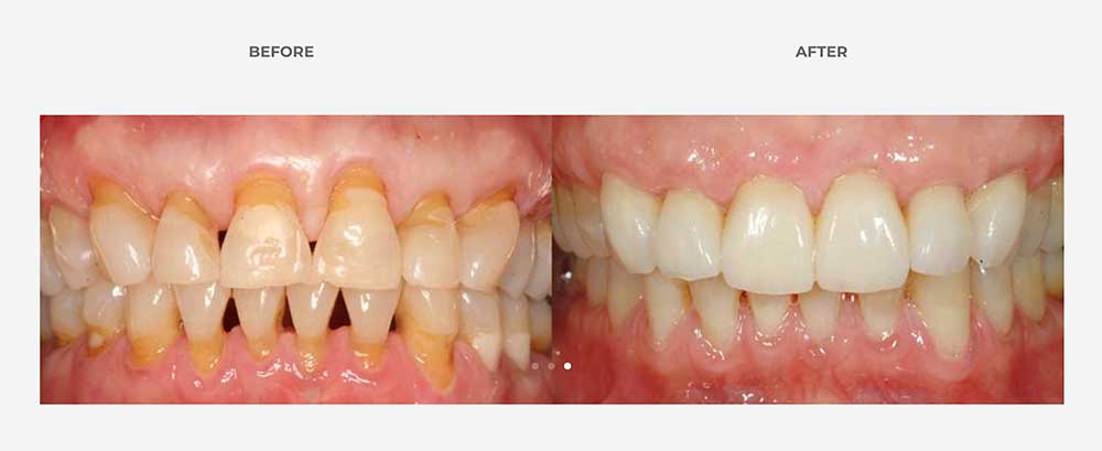 before and after gum grafting to fix gum recession
