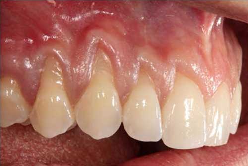 Traditional Dentures being shown to patient