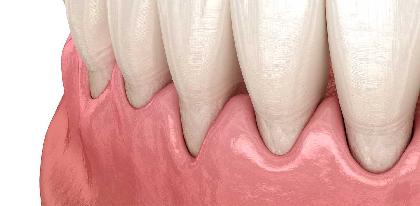 How to Fix Receding Gums - IMPLANT PERIO CENTER