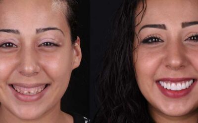 Gums Contouring and Reshaping: What is it?