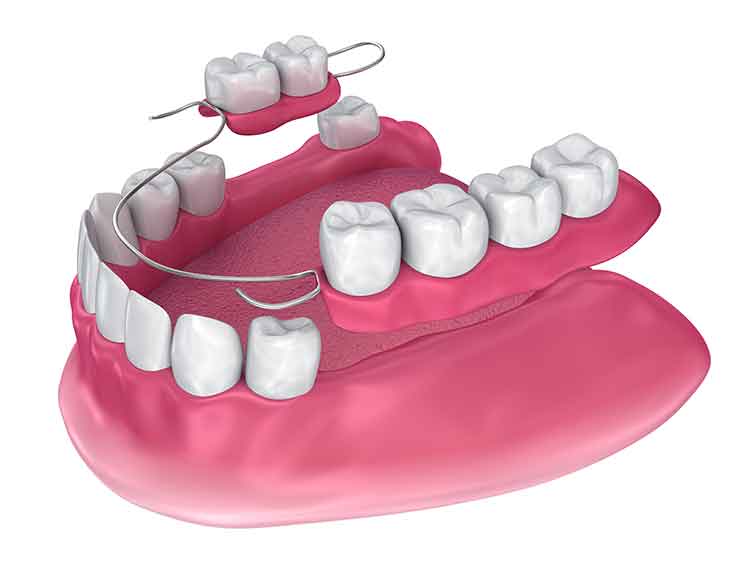 removable dentures