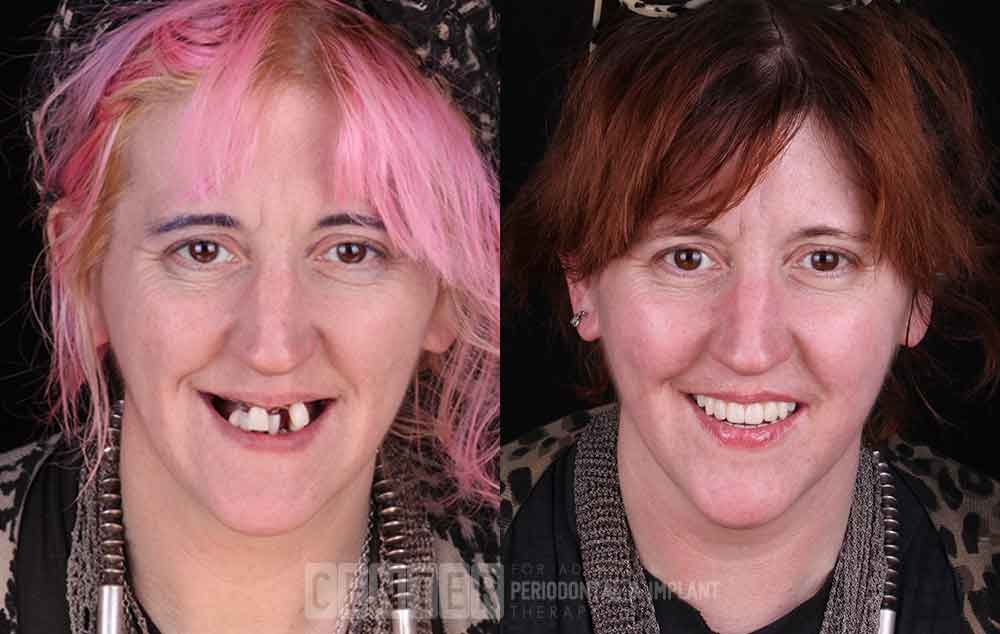 zygomatic implants before and after