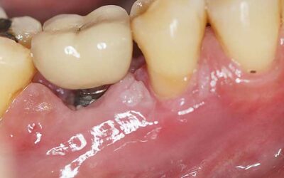 What You Must Know About Gum Disease & Dental Implants