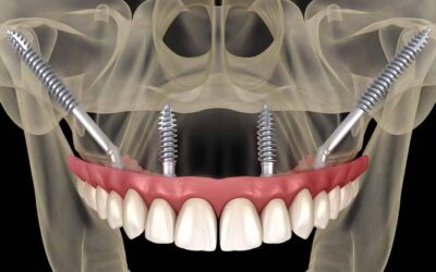 How Do Zygomatic Dental Implants Work?