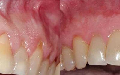 Gum Surgery Can Enhance Your Smile And Rescue Your Teeth