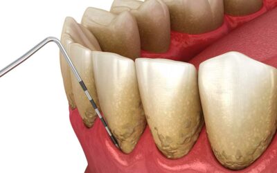 Options For Saving A Tooth Before You Replace It