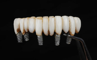 The Truth About Cheap Dental Implants