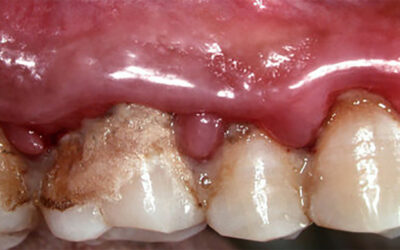 Can I Get Dental Implants With Severe Gum Disease