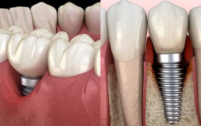How To Prevent An Infection After Getting Dental Implants
