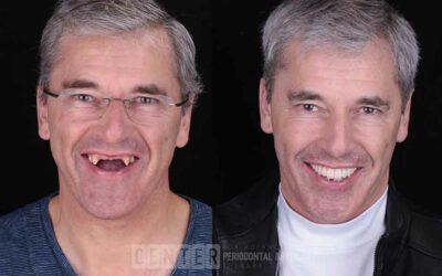 Can You Get Dental Implants Years After Extraction?