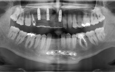 Understanding Bone Resorption Causes, Complications, and Regeneration Treatments