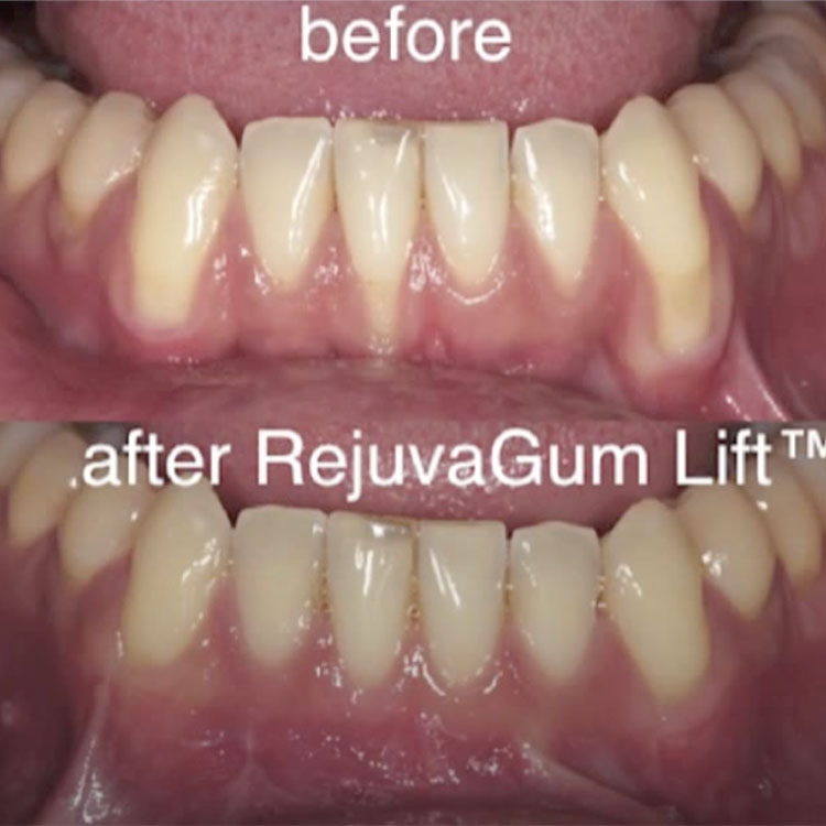 RejuvaGum Lift before after Los Angeles patient results