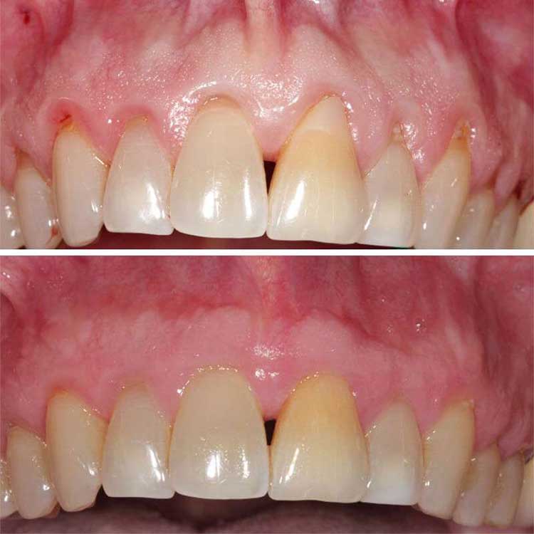 RejuvaGum-Lift-receeeding-gums-lp