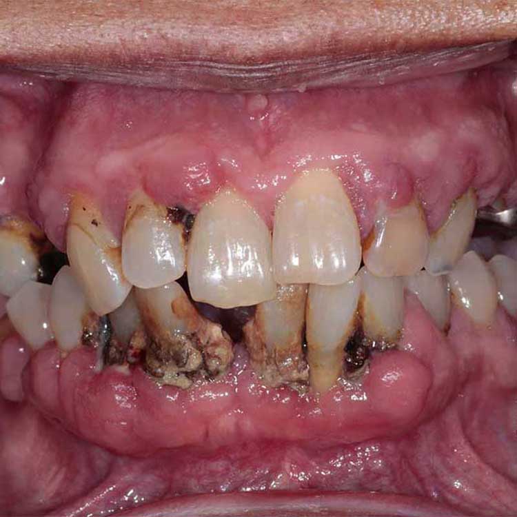 gum-disease-patient-before-treatment-lp