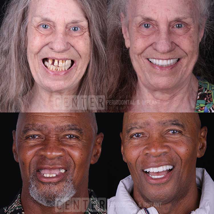 missing-teeth-dental-Implant-before-after-lp
