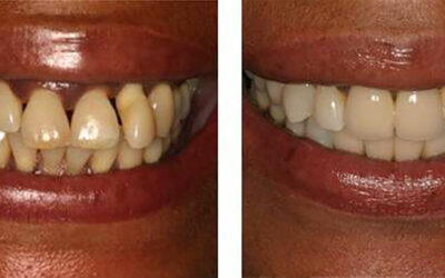 Life-Changing Cosmetic and Health Benefits of Dental Implants