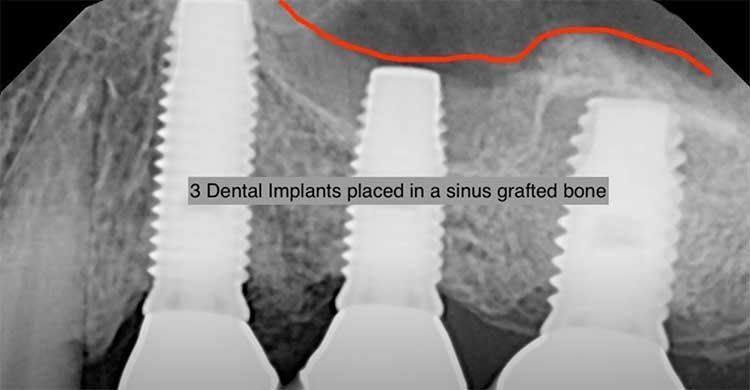  implants placed after sinus grafted bone