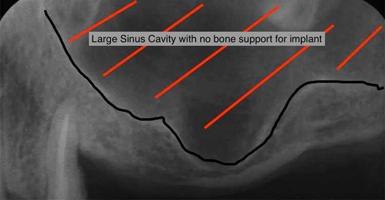sinus cavity with no bone support