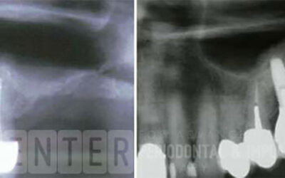 Why Sinus Lift? Understanding Its Role in Dental Implant Procedures