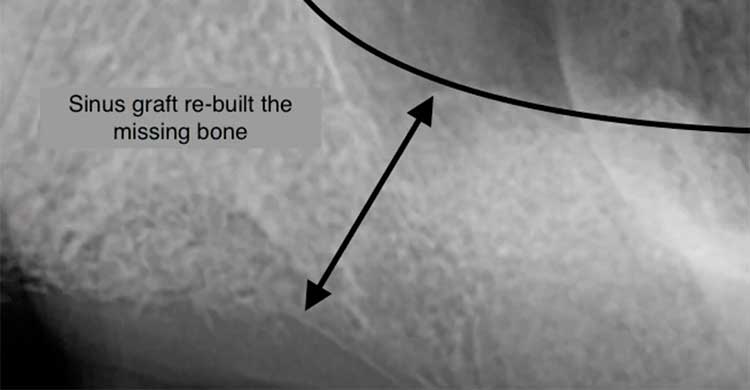 Sinus graft re-built bone