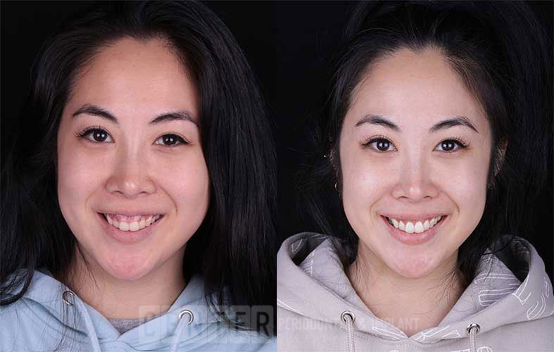 Gum Overgrowth and the Causes Behind Gums Growing Over Teeth IMPLANT PERIO CENTER
