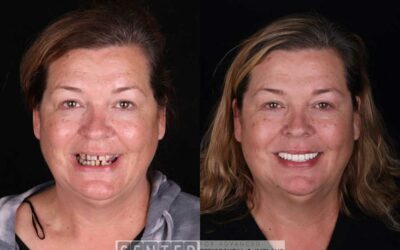 Elevating Dental Implant Standards in Los Angeles for Patient Safety