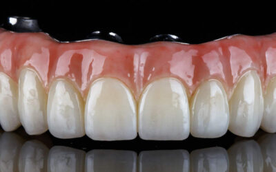 Considering Dental Implants in Santa Monica? What You Should Know Before Getting Started