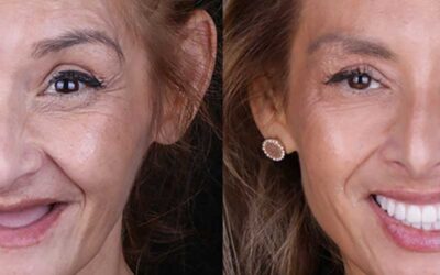 Comparing Full Mouth Restoration Options in Los Angeles: Implants, Bridges, and Hybrid Solutions