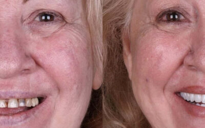 Same-Day Full-Arch Dental Implants in Los Angeles: Never Go Without Teeth