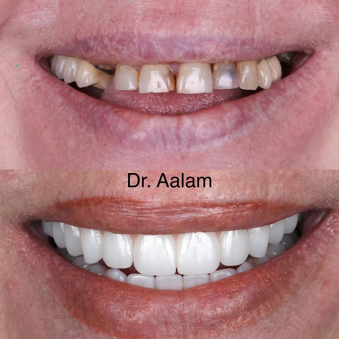 same-day-implants-los-angeles-ca-2