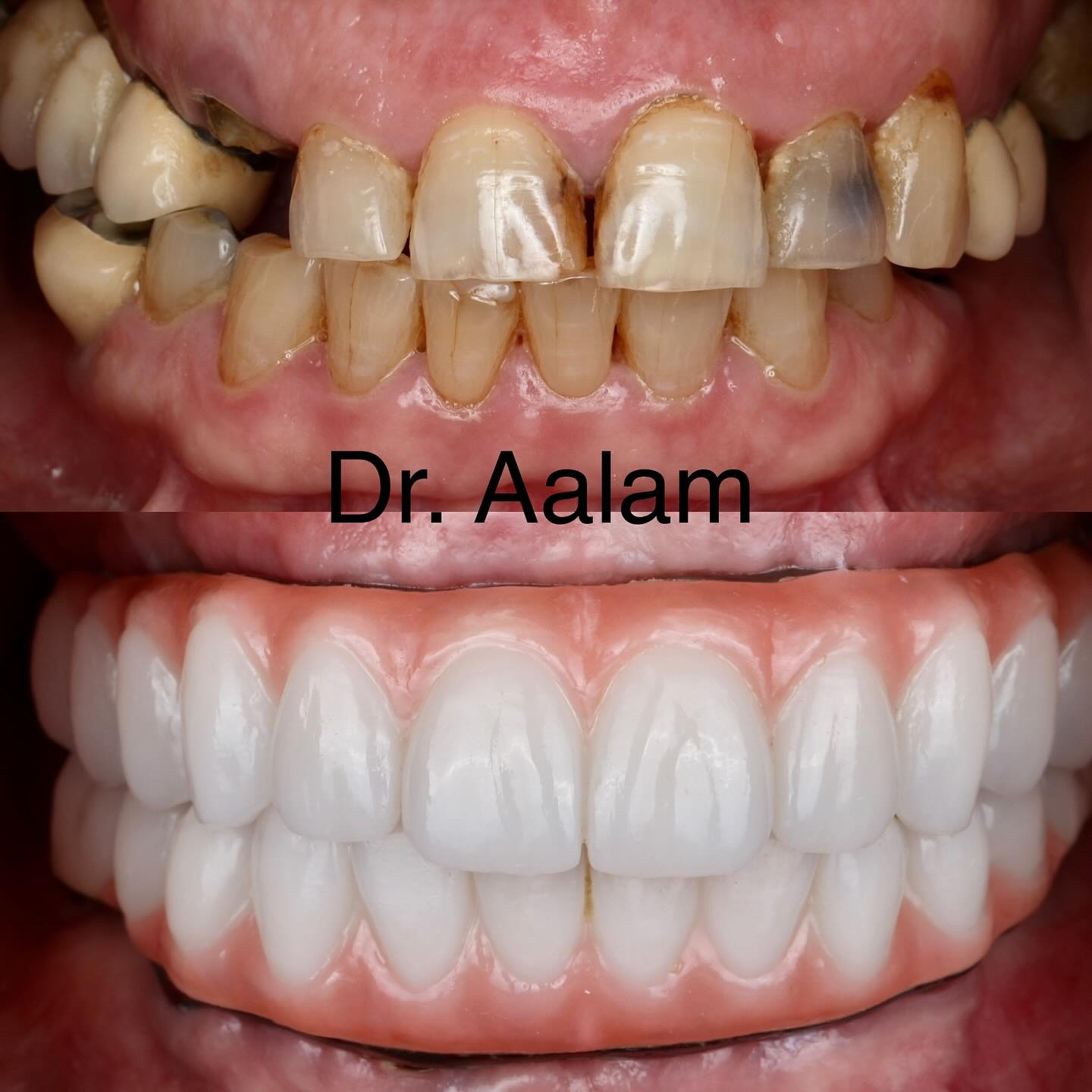 same-day-implants-los-angeles-ca-3