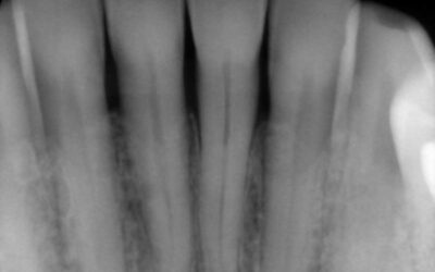 Bone Loss Explained: Causes, Progression, and Protection Before Tooth Loss