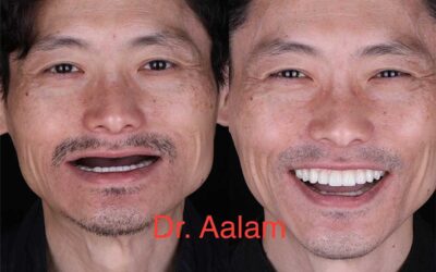 Is Your Dental Implant Failing? Signs, Causes, and When a Periodontist May Be Able to Save It