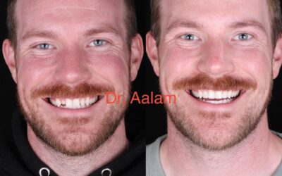Are Dental Implants Covered by Insurance? A Los Angeles Patient’s Guide