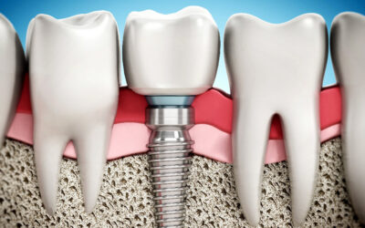 Dental Implants with Osteoporosis or Bisphosphonates: What Los Angeles Patients Should Know